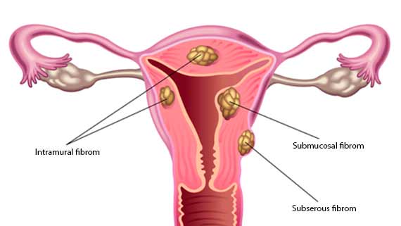 Fibromer er muskelknuder, der ikke er kræft på livmoderen.