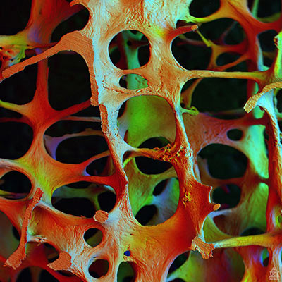 Elektronmikroskop billede, der viser osteoporotisk arkitektur i den fjerde lændehvirvel af en 89-årig kvinde. Knoglen er stærkt eroderet pga. osteoklaster og består hovedsageligt af tynde, skrøbelige stivere. Foto: Alan Boyde/Oregon State University